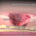 The Importance of Proper Application of Barrier Cream for Bed Sores