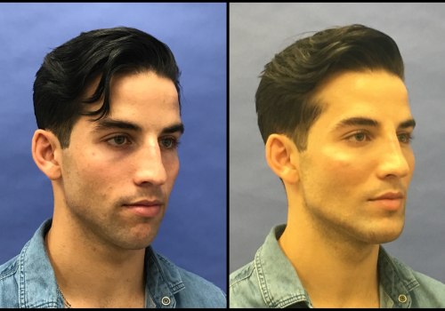 The Psychology Behind Plastic Surgery: Exploring the Reasons and Risks